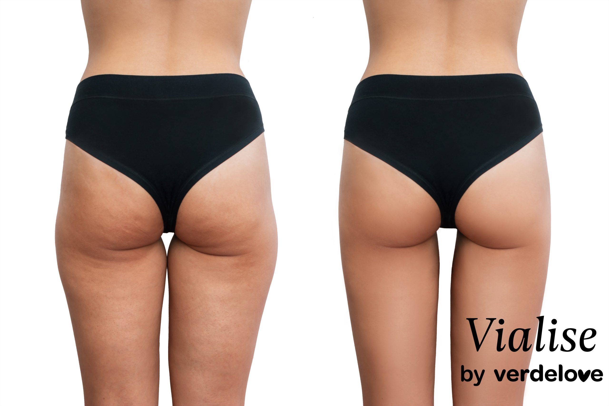 cellulit na lydkach pokonaj go z vialise.pl scaled